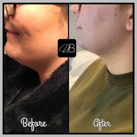 Fat dissolving for jawline