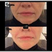 How do you do nasolabial filler