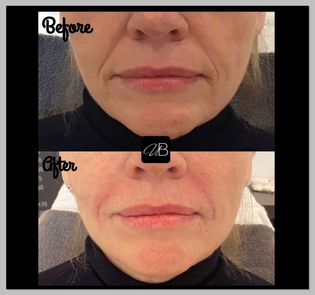 How do you do nasolabial filler
