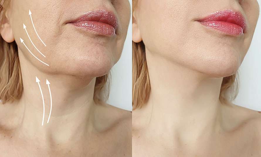 Woman,Double,Chin,Before,And,After,Treatment