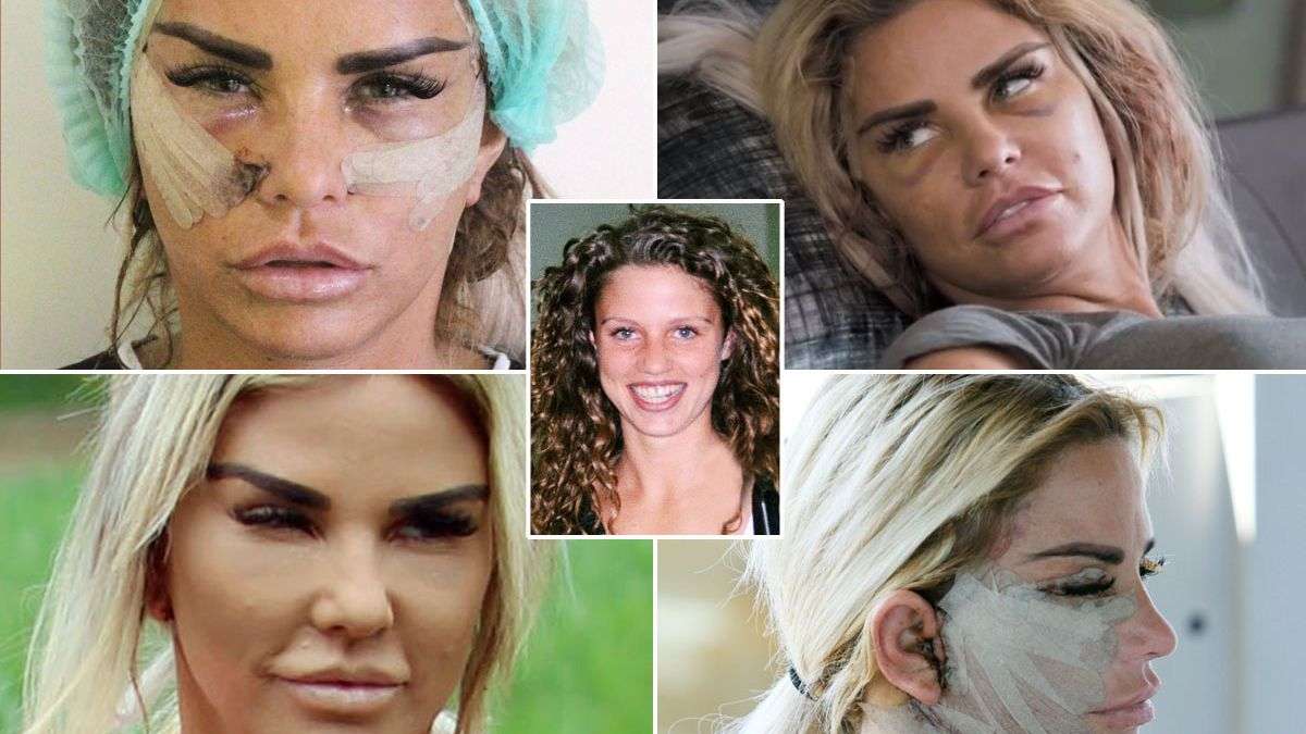 Katie Price facelift